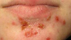 أعراض مرض الهربس وطرق الوقاية منه