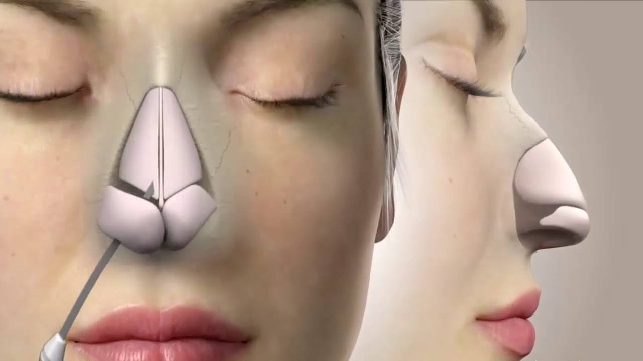 6 أسباب لتضخم غضاريف الأنف.. منها نزلات البرد