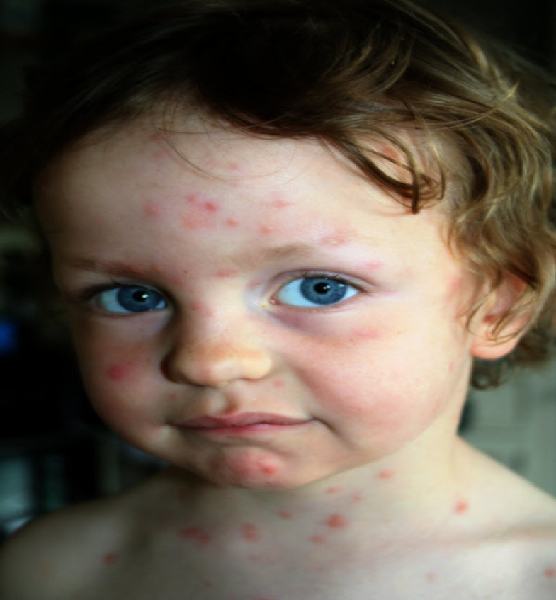 كل ما تحتاج معرفته عن التهاب السحايا عند الأطفال