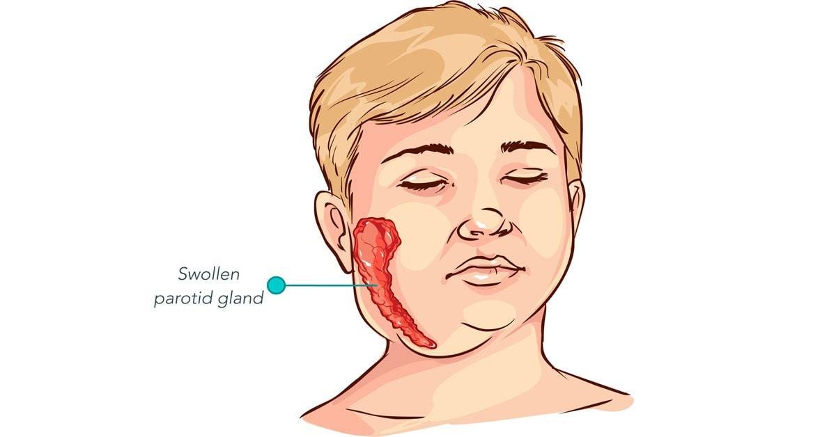 أبو كعب عند الأطفال.. كيف تكتشف النكاف مبكرًا وتتجنب مضاعفاته؟