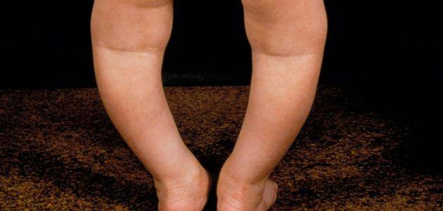 أعراض نقص الكالسيوم عند الأطفال.. تعرف عليها