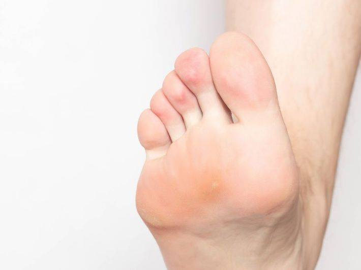 كيف أتخلص من مسمار القدم بفعالية في المنزل؟