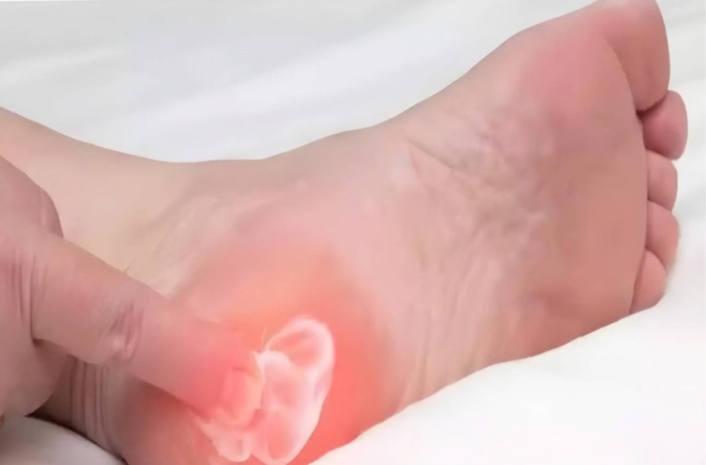 كيف أتخلص من مسمار القدم بفعالية في المنزل؟