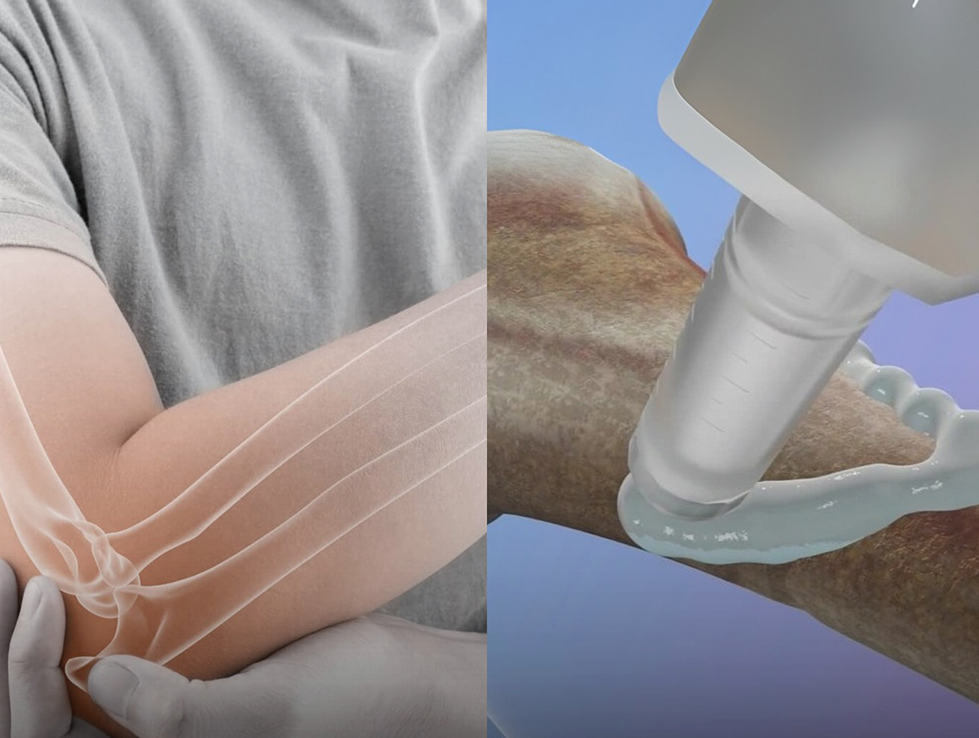 علماء صينيون يبتكرون &laquo;غراء للعظام&raquo; يصلح الكسور في 3 دقائق فقط