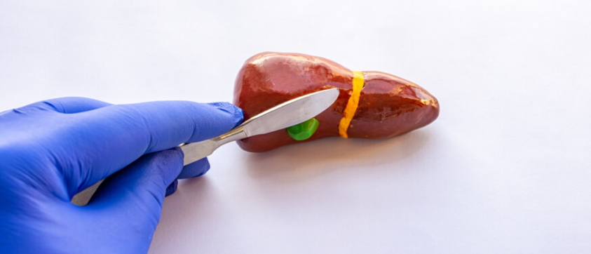 تحذير بعد عملية المرارة.. تناول الدهون قد يسبب هذه المشكلات الخمس