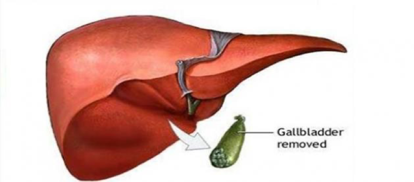 تحذير بعد عملية المرارة.. تناول الدهون قد يسبب هذه المشكلات الخمس
