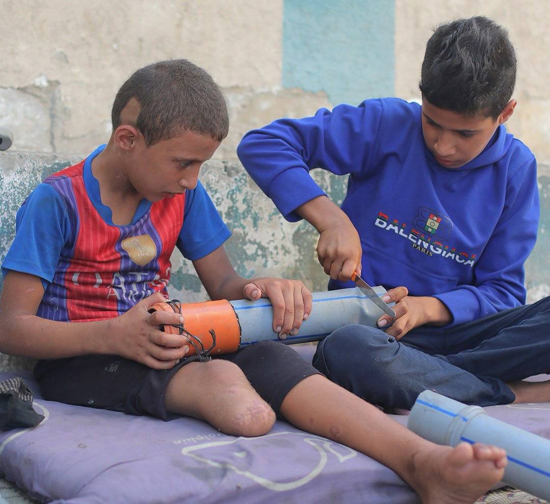 أنـبوب بـلاسـتيكي بـدل ساق الطفل راتب.. مأساة ابن الـ9 أعوام جزء من حكاية إبادة غزة