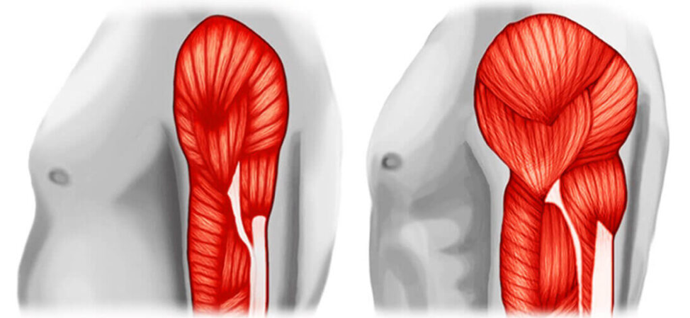 مرض ضمور العضلات.. كيف يبدأ وما علاجه؟