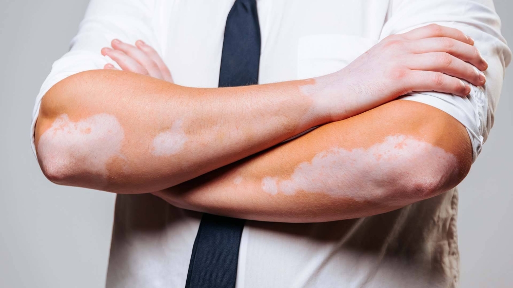 هل تعاني من تصبغ جلدك؟ وما هو البهاق البهاق؟