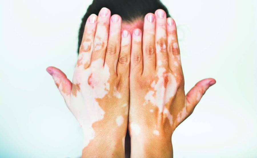 هل تعاني من تصبغ جلدك؟ وما هو البهاق البهاق؟