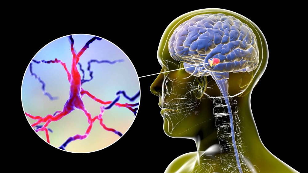 الأطباء ينجحون في معالجة داء هنتنغتون بنجاح لأول مرة