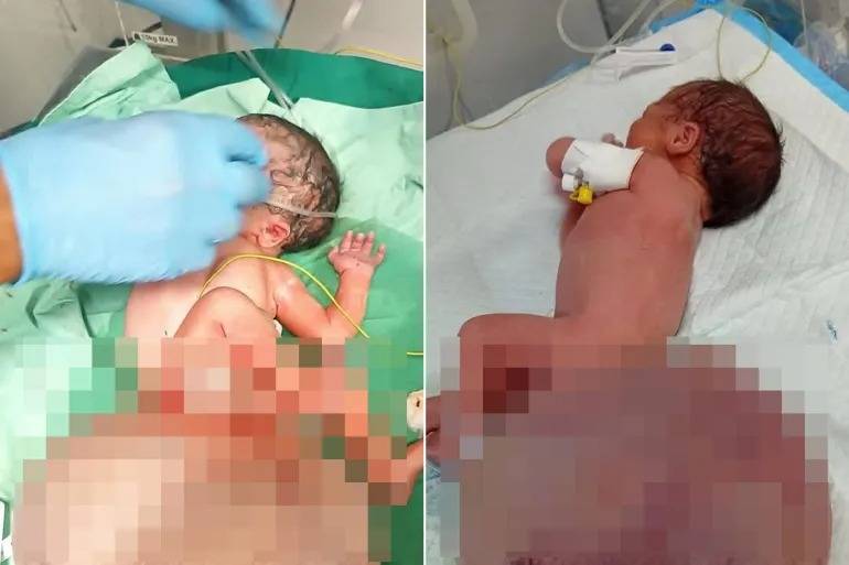 طفلة تولد بورم نادر بغزة.. صرخة حياة تصبح شاهدا على الكارثة الإنسانية