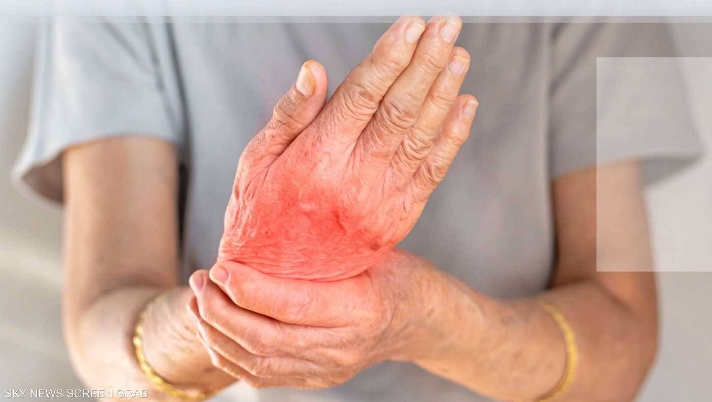 ما هو مرض التهاب المفاصل الروماتيدي ومتى نزور الطبيب؟