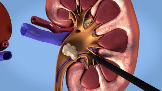 7 نصائح ذهبية لتخفيف آلام حصوات الكلى ومنع تكونها