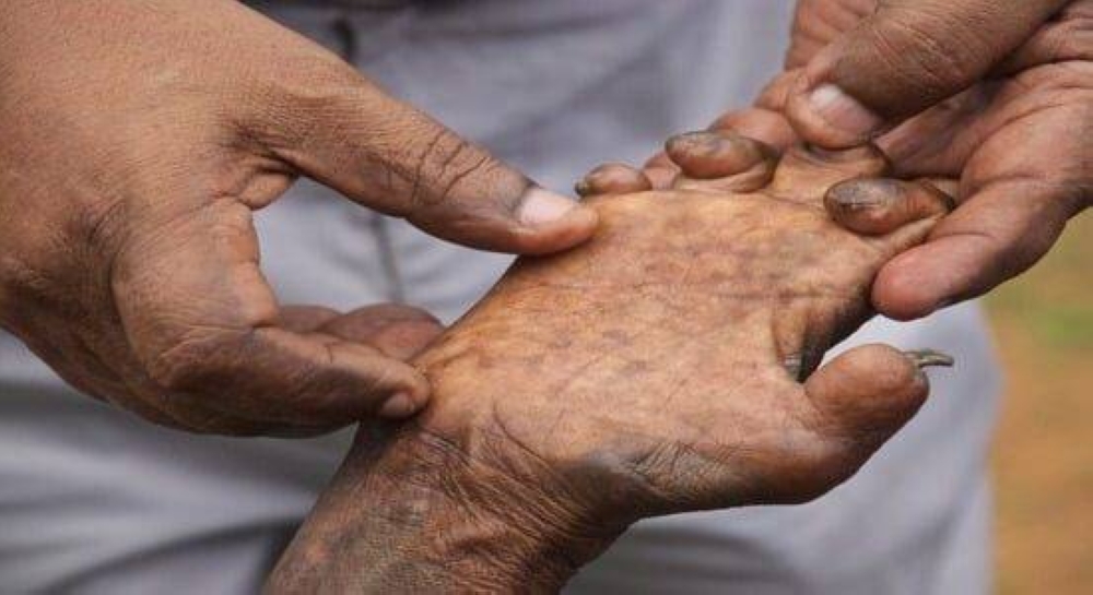 هل اختفى الجذام فعلًا؟.. 200 ألف إصابة جديدة سنويًا تكشف الحقيقة