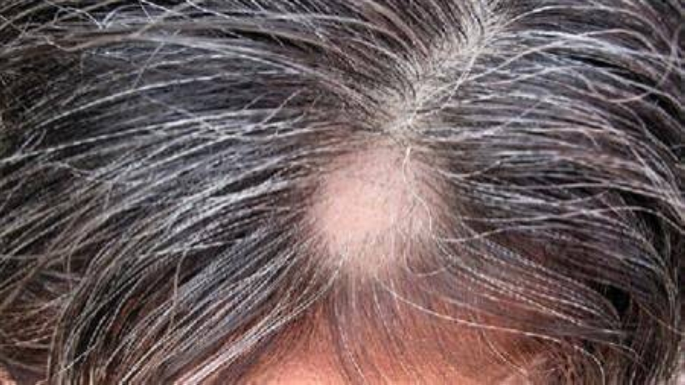 كيف تعرف أن فروة رأسك متحسسة من الشامبو أو الصبغة؟