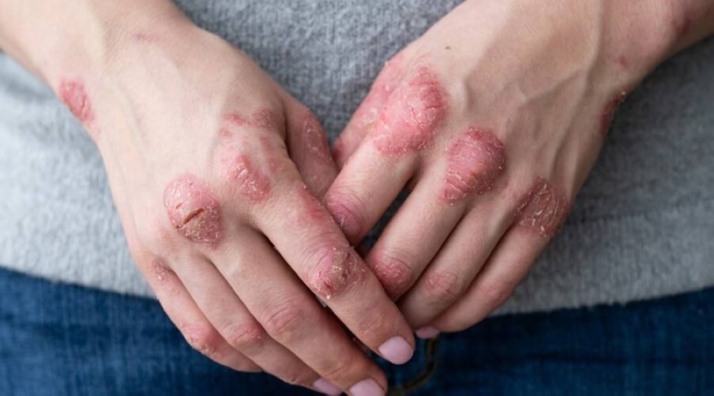 تغير الأظافر وحكة مستمرة.. 6 علامات صادمة تكشف إصابتك بالصدفية؟