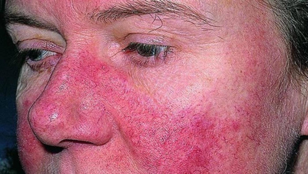 تعرف على كل ما يخص مرض الذئبة الحمراء وأبرز الأعراض الشائعة