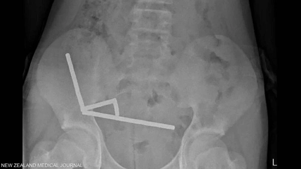 صبي في نيوزيلندا يبتلع 100 مغناطيس اشتراها من &laquo;تيمو&raquo;.. والشركة تعلق