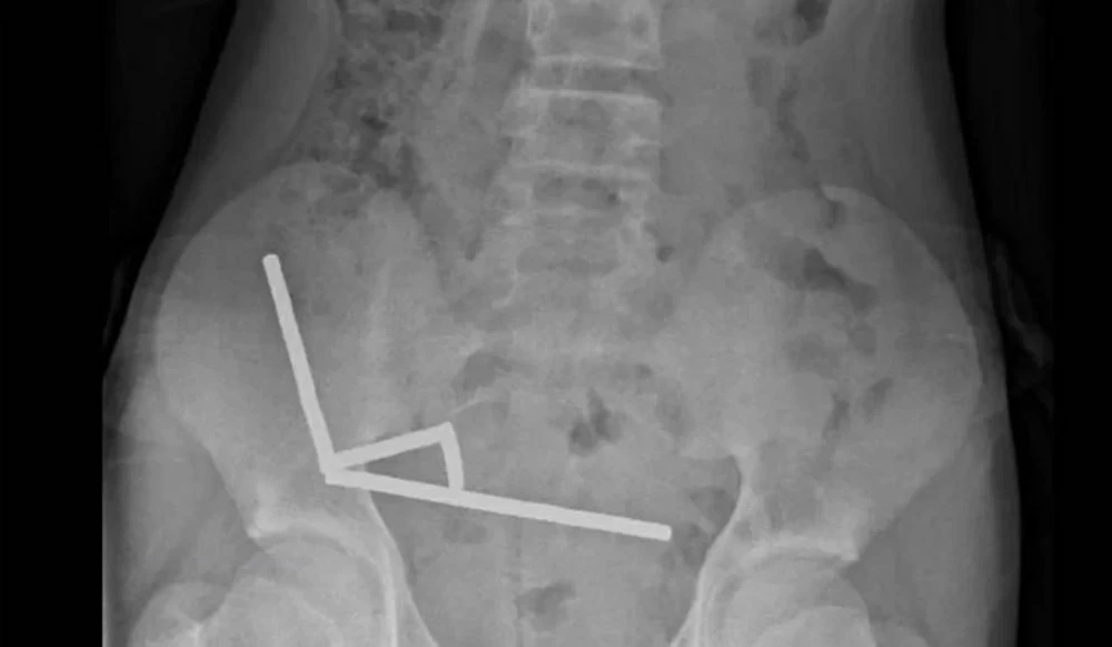 إزالة 100 مغناطيس من أمعاء مراهق في نيوزيلندا