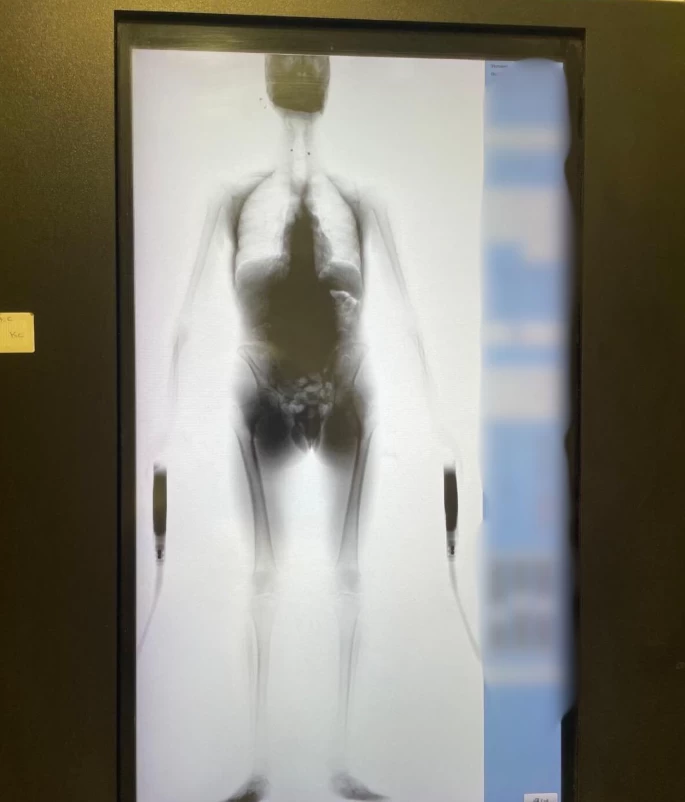 الكويت: إحباط تهريب مخدرات داخل أحشاء مسافر أوروبي قادم من لندن