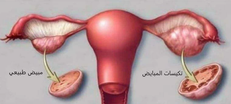 الأخصائية صفاء الدبيس تحذر من ارتباط تكيس المبايض بالسكري والكوليسترول