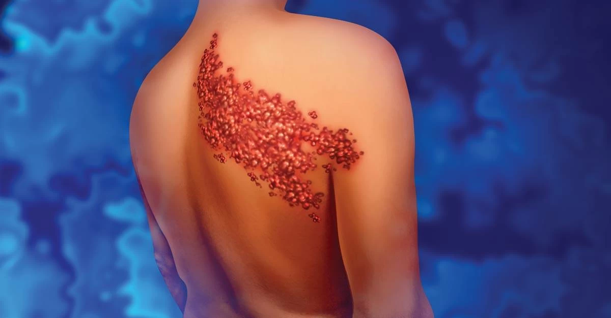 جمعة: لقاح الحزام الناري حماية للفرد والمجتمع ومتوفر بالمراكز الصحية 