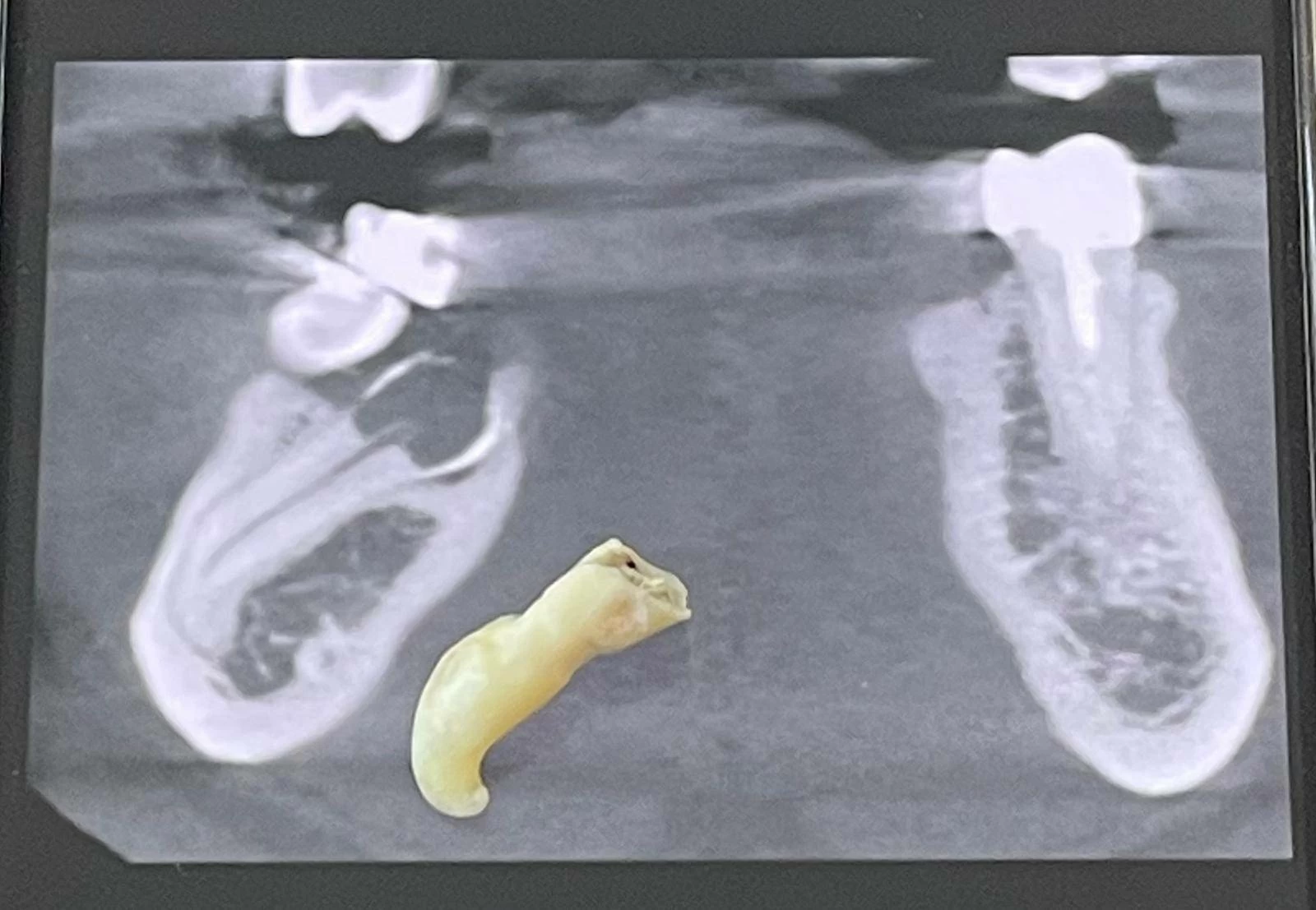 محمد قحطان: الخلع الجراحي للسن غير ممكن إلا على يد مختصين فقط 