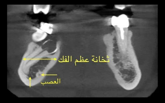 محمد قحطان: الخلع الجراحي للسن غير ممكن إلا على يد مختصين فقط