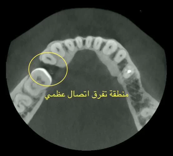 محمد قحطان: الخلع الجراحي للسن غير ممكن إلا على يد مختصين فقط