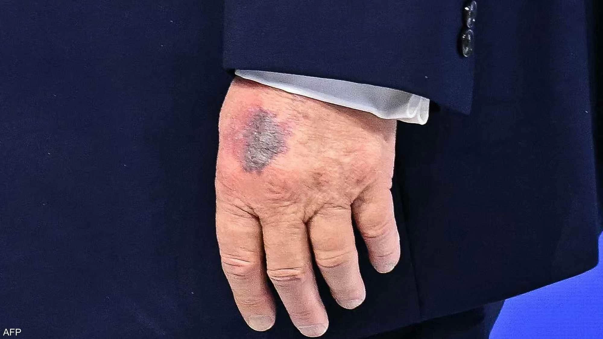 الطاولة أم المصافحة.. تضارب في رواية &laquo;كدمة ترامب&raquo;