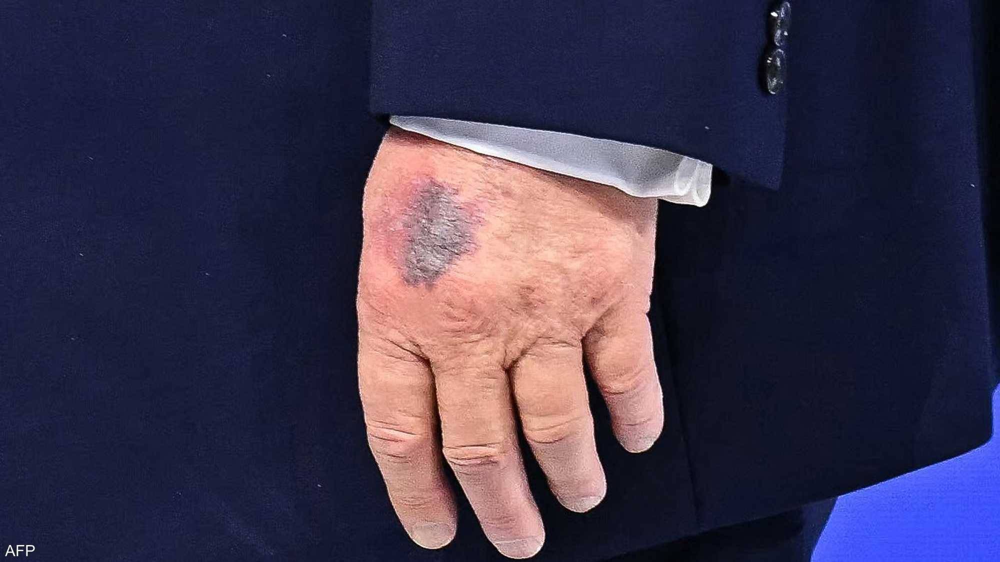 الطاولة أم المصافحة.. تضارب في رواية «كدمة #ترامب» 