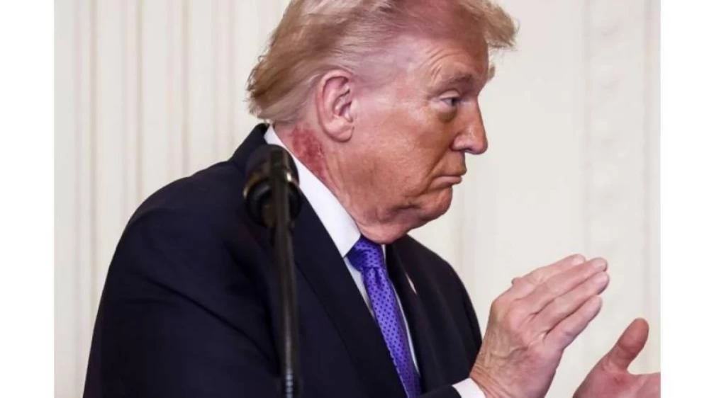 بعد ظهورها في أحدث صوره.. ما حقيقة البقعة الحمراء على رقبة دونالد ترامب؟